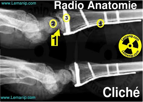 Radiographie Chirurgicale du Poignet Incidences Clichés