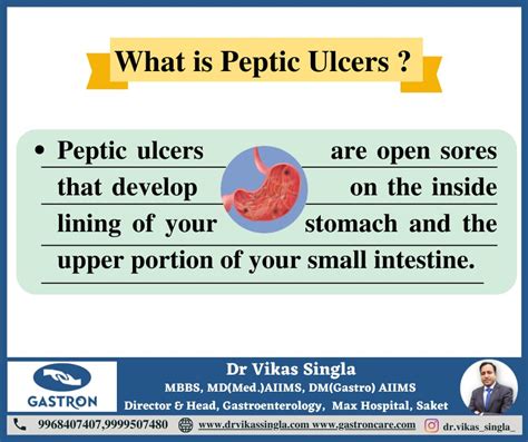 Peptic Ulcer Causes Symptoms And Tips Dr Vikas Singla