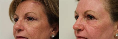 Renuvion J Plasma Skin Tightening Before And After Pictures Case