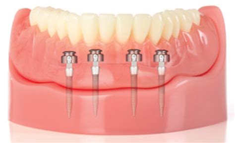 Mini Dental Implants Registered Dental Hygienists