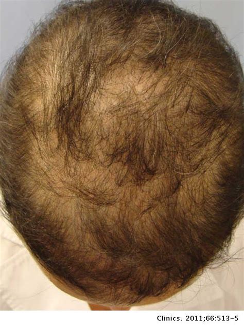 Alopecia Areata Incognita Clinics