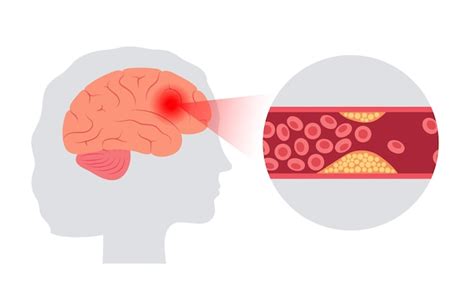 Premium Vector Brain Stroke Ishemic And Hemorrhagic