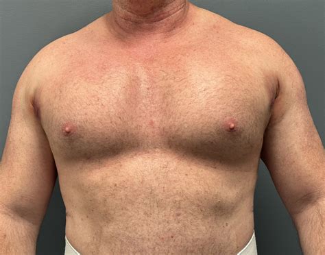 Plastic Surgery Case Study XL Custom Male Pectoral Implants Explore