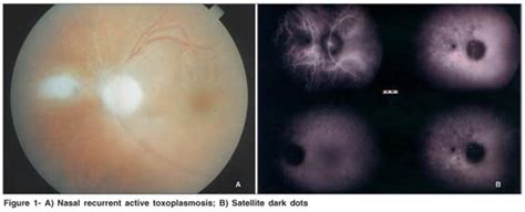 Scielo Brasil Remote Hypofluorescent Dots In Recurrent Ocular