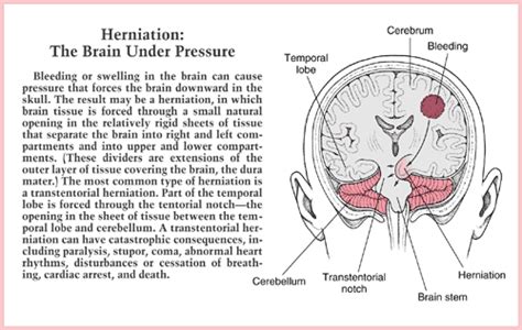 ICP:Increased Intracranial Pressure | Chiari malformation, Intracranial ...