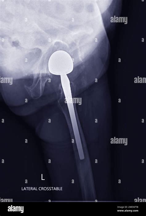 An X Ray Reveals Both Hip Joints With Total Hip Arthroplasty