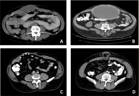 Postoperative Seroma Can Present As A Clinical Bulge Anterior A Or