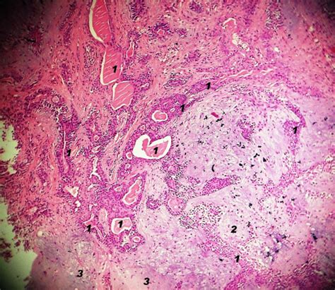 Photomicrograph Of Pleomorphic Adenoma Showing Epithelial Component Download Scientific Diagram