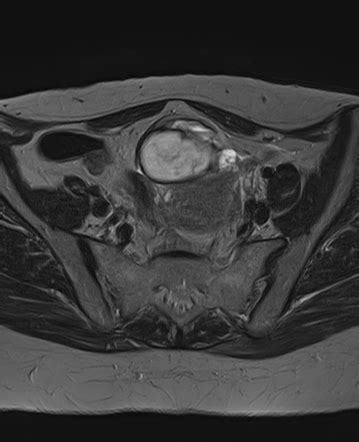 Adult Granulosa Cell Tumour Of The Ovary Radiology Reference Article