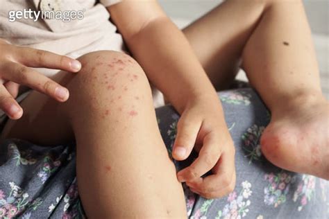 Boy Showing His Knee Infected With Hand Feet And Mouth Disease Or Hfmd