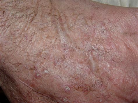 Medical Pictures Info Actinic Keratosis Picture