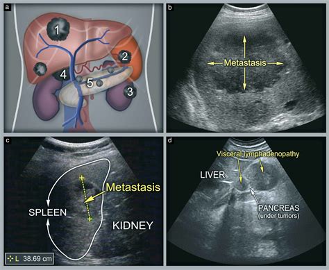 Ultrasound Scanning Of The Pelvis And Abdomen For Staging Of