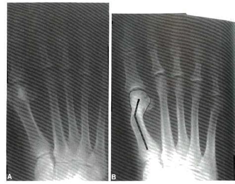 Figure 2 From Comparison Of Chevron Osteotomy And Modified Mcbride