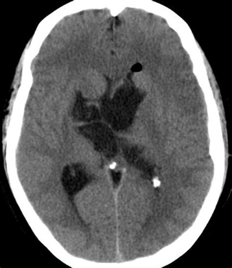 Intraventricular Epidermoid Cyst Neurorad911