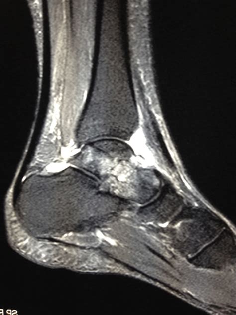 Ankle Sprain Mri