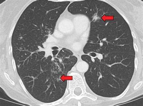 Noninfectious Granulomatous Diseases Of The Chest Radiographics