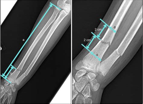 Fracture At The Metadiaphyseal Junction Mdj Was Defined As A Fracture