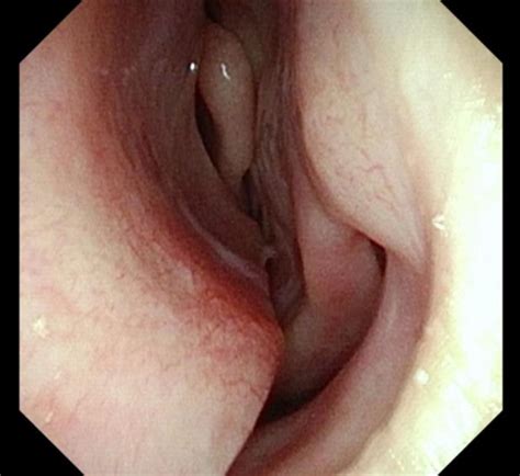 My Nose Is Always Blocked On One Side The Deviated Septum Dr Jeeve