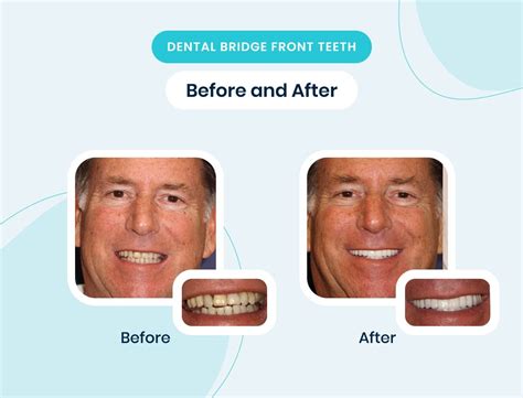 How Much Does A Dental Bridge Cost A Price Breakdown With And Without