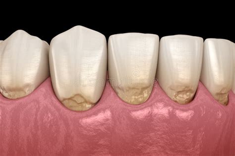 Abfraction Of Anterior Teeth Medically Accurate 3D Illustration Stock