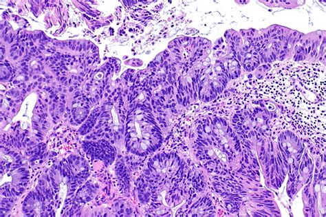 Adenocarcinoma Of The Urinary Bladder Libre Pathology