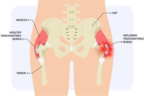 Proximal Hamstring Repair Rockwall TX Manoj Reddy