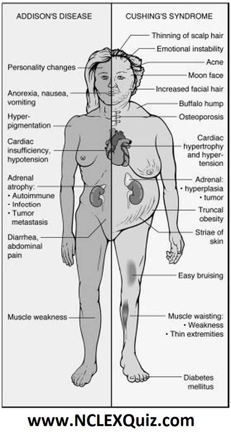 Cushings Syndrome Cartoon