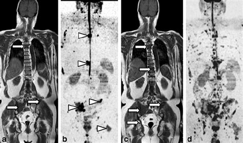 Follow Up Of Bone Metastatic Disease In A Man With Breast Cancer During