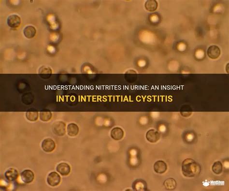 Understanding Nitrites In Urine: An Insight Into Interstitial Cystitis