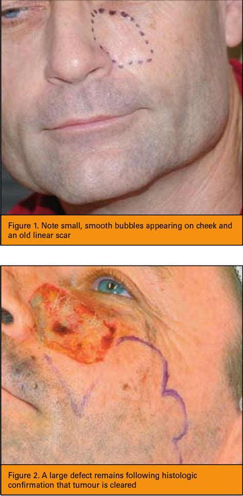 Figure 1 From Micronodular Basal Cell Carcinomas Semantic Scholar