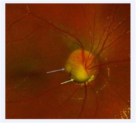 Figure 3 from Optic Nerve Cyst Associated with Optic Disc Pit in a ...