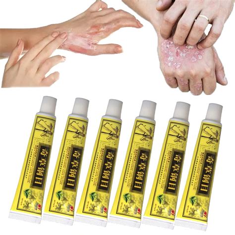 Buy Duhanxi Natural Chinese Al Eczema Psoriasis Creams Itchy Skin Fast