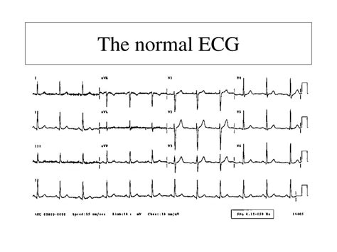 Normal ECG Waves Of An EKG