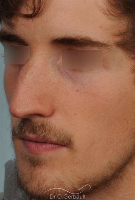 Photos De Rhinoplastie Chez L Homme Avant Et Apr S