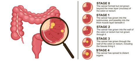 Dickdarmkrebs Ursachen Und Diagnostik