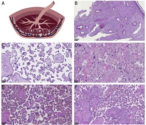 Examples of placental pathology. (A) Schematic macroscopic view of the ...