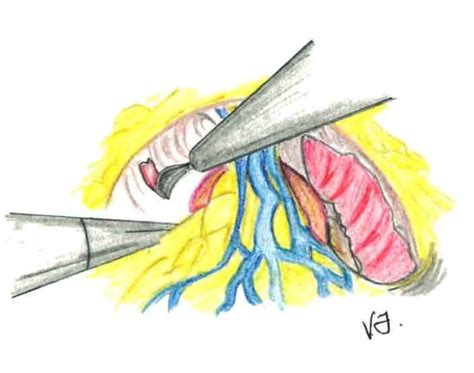 Laparoscopic Radical Prostatectomy | IntechOpen