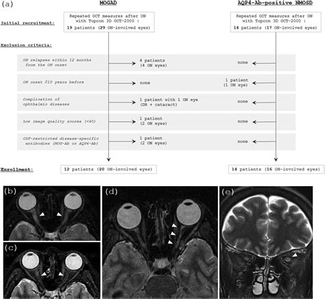 Follow Up Of Retinal Thickness And Optic Mri After Optic Neuritis In Anti Mog Antibody