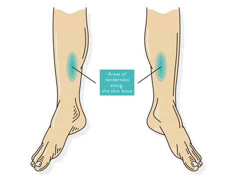 Shin Splints: Causes, Symptoms & Treatment | The Foot Hub