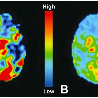 Dynamic Susceptibility Contrast MRI Perfusion Panels A And B Show