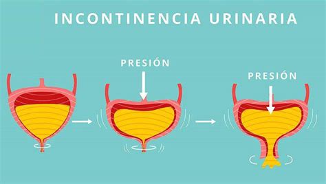 5 hábitos para tratar la incontinencia urinaria Salud La Revista