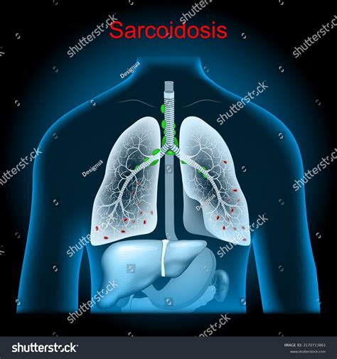 Sarcoidosis Enlarged Lymph Nodes Lungs Granulomas Stock Vector Royalty