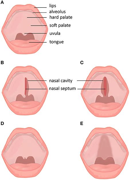 Frontiers | Epidemiology, Etiology, and Treatment of Isolated Cleft Palate | Physiology