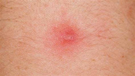 What’s On My Skin? 8 Common Bumps, Lumps and Growths | Skin Disorders ...