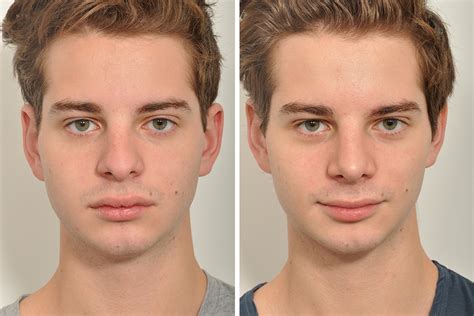 Rhinoplasty Nose Surgery Nose Job For Men In New York City David Rosenberg M D Pllc