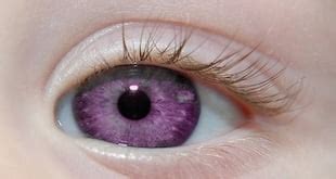 Purple Eye Disease - Symptoms And Causes