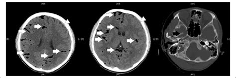 Ct Brain Showed Air Bubbles In The Subarachnoid Spaces White Arrows