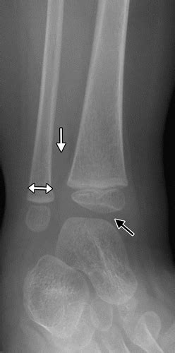 Normal Pediatric Ankle Xray