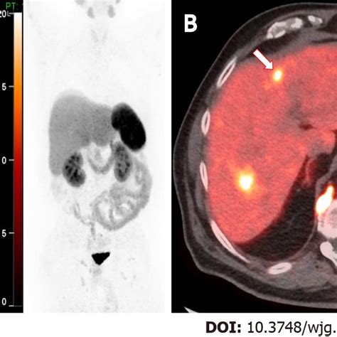 Ga Dotatate Positron Emission Tomography Computed Tomography