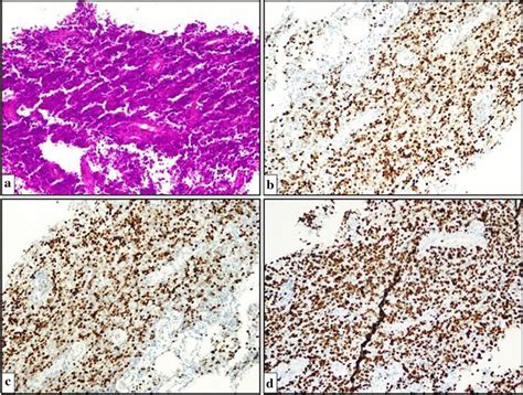 Microscopic Image Of Diffuse Large B Cell Lymphoma A Diffuse Growth